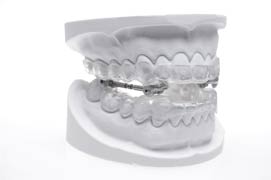 Schnarchschiene (© Dr. Hinz KFO-Labor)